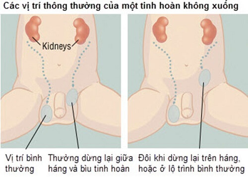 Tinh hoàn lạc chỗ